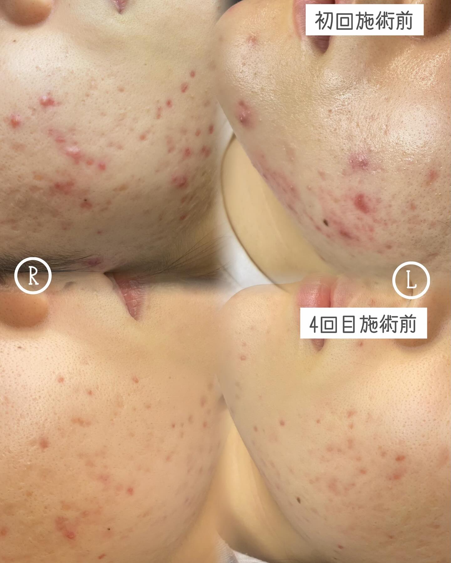 *マッサージピールの効果✨