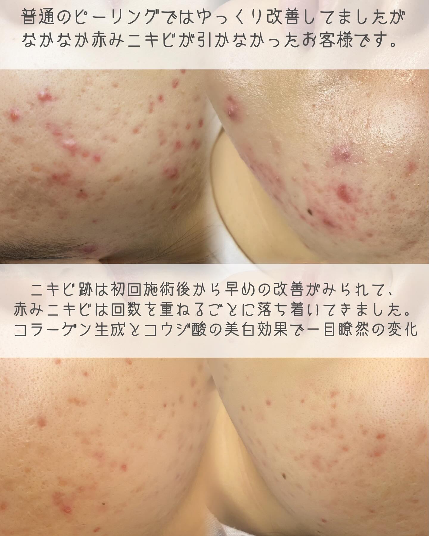 *マッサージピールの効果✨