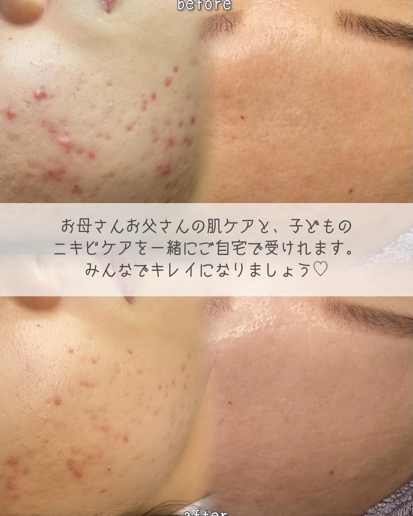 *マッサージピールの効果✨