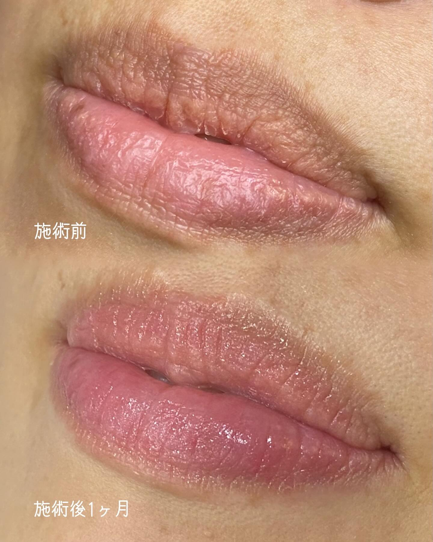 色素除去（RomaPink）メラニンケア