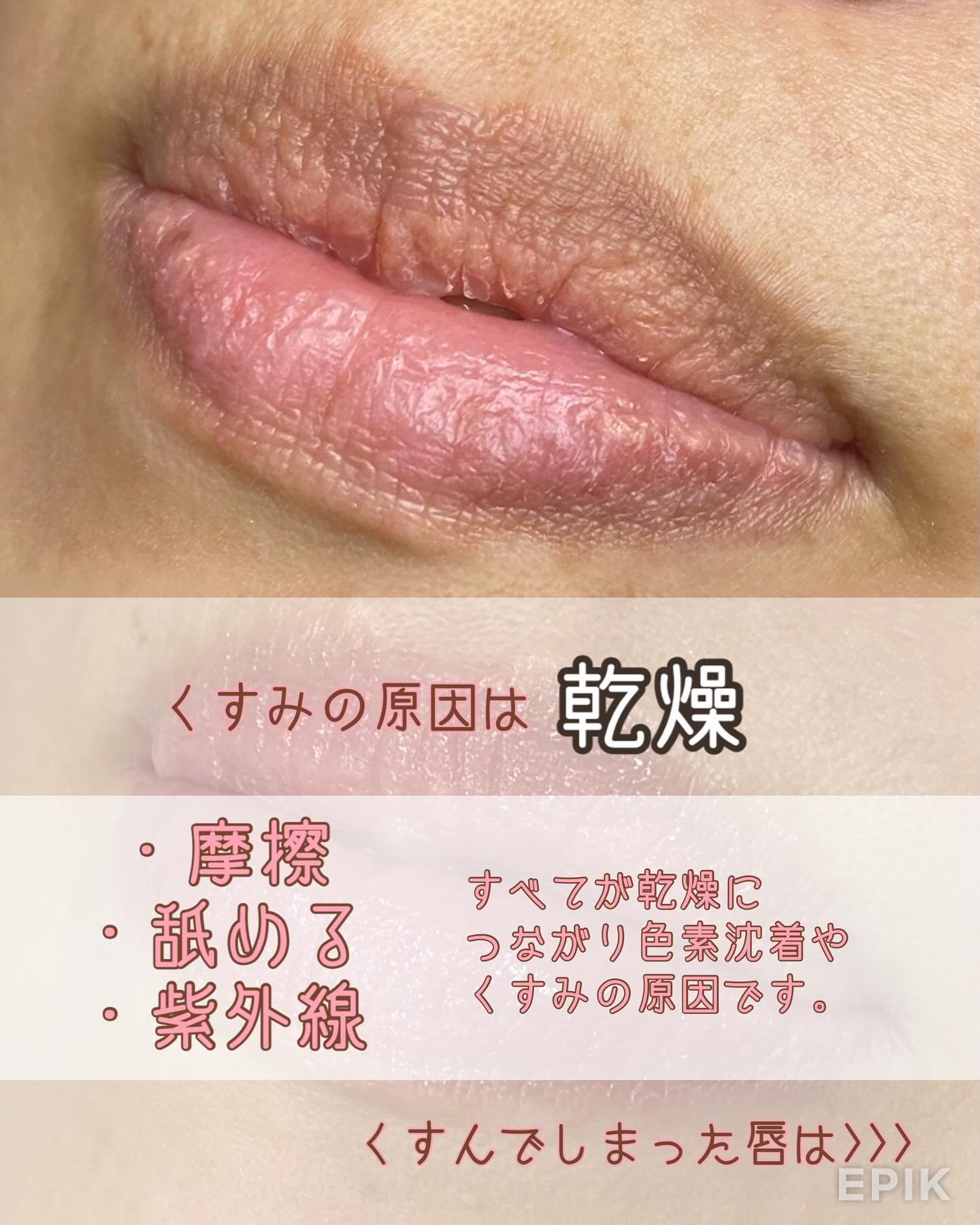 色素除去（RomaPink）メラニンケア