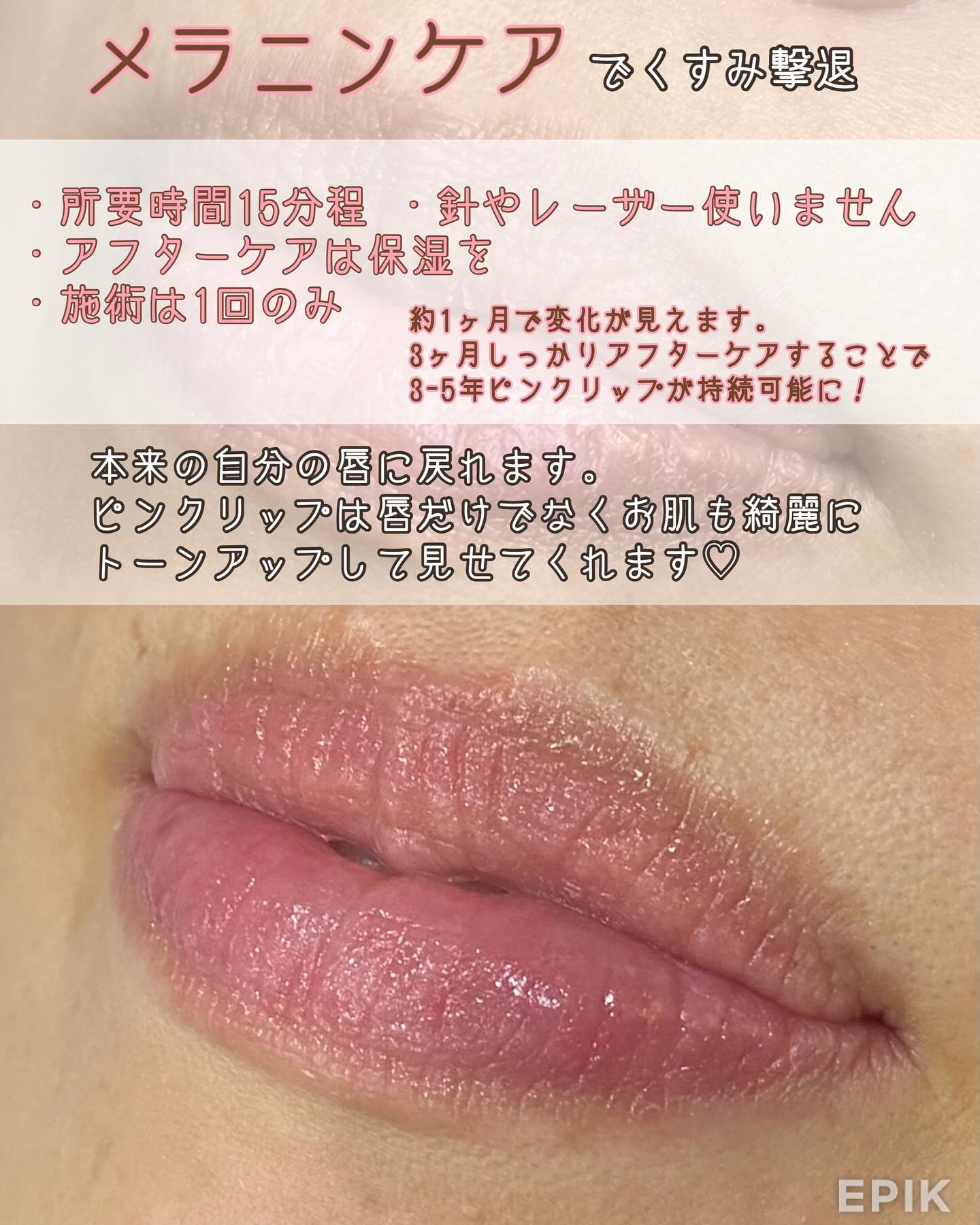 色素除去（RomaPink）メラニンケア