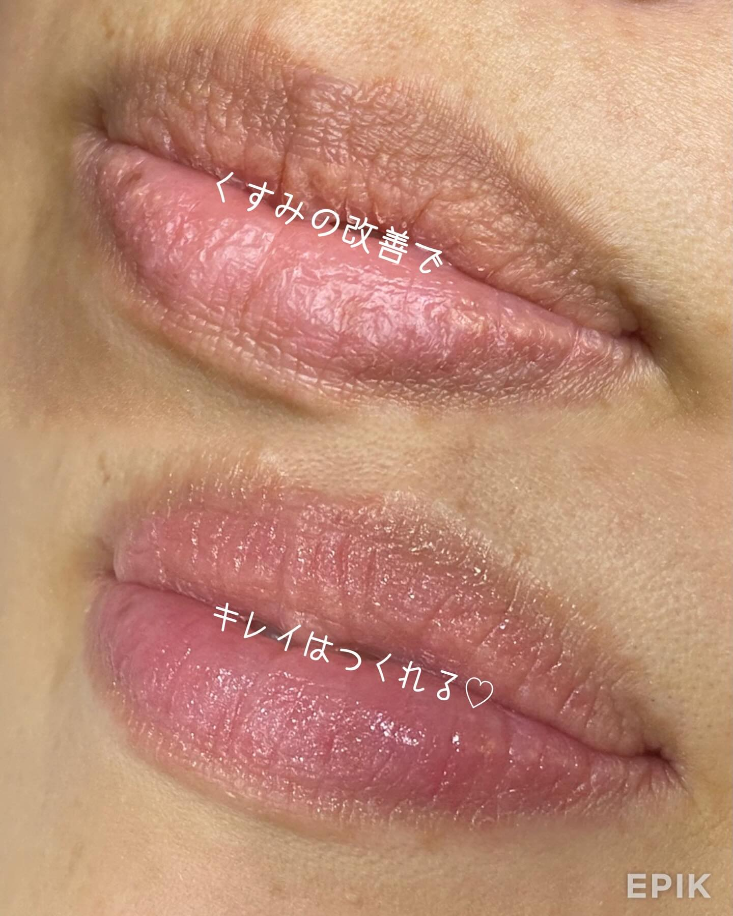 色素除去（RomaPink）メラニンケア