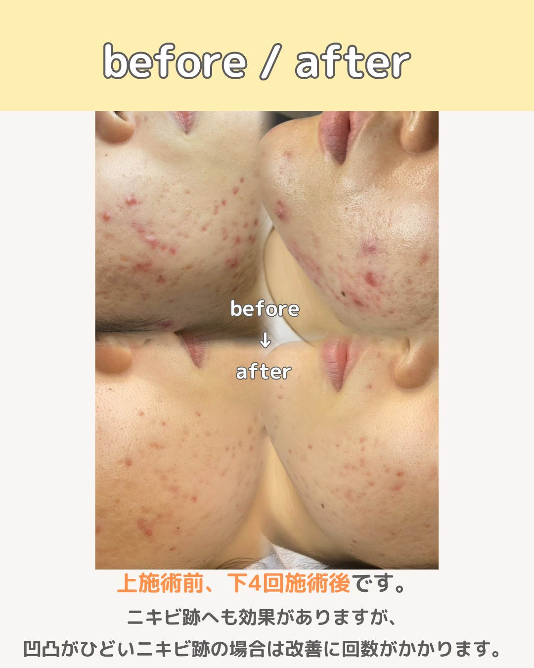 ニキビを早く治す方法