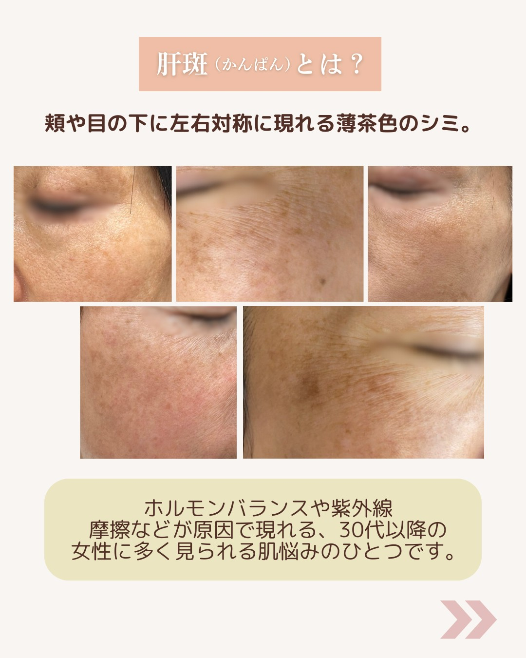 「これって肝斑?」