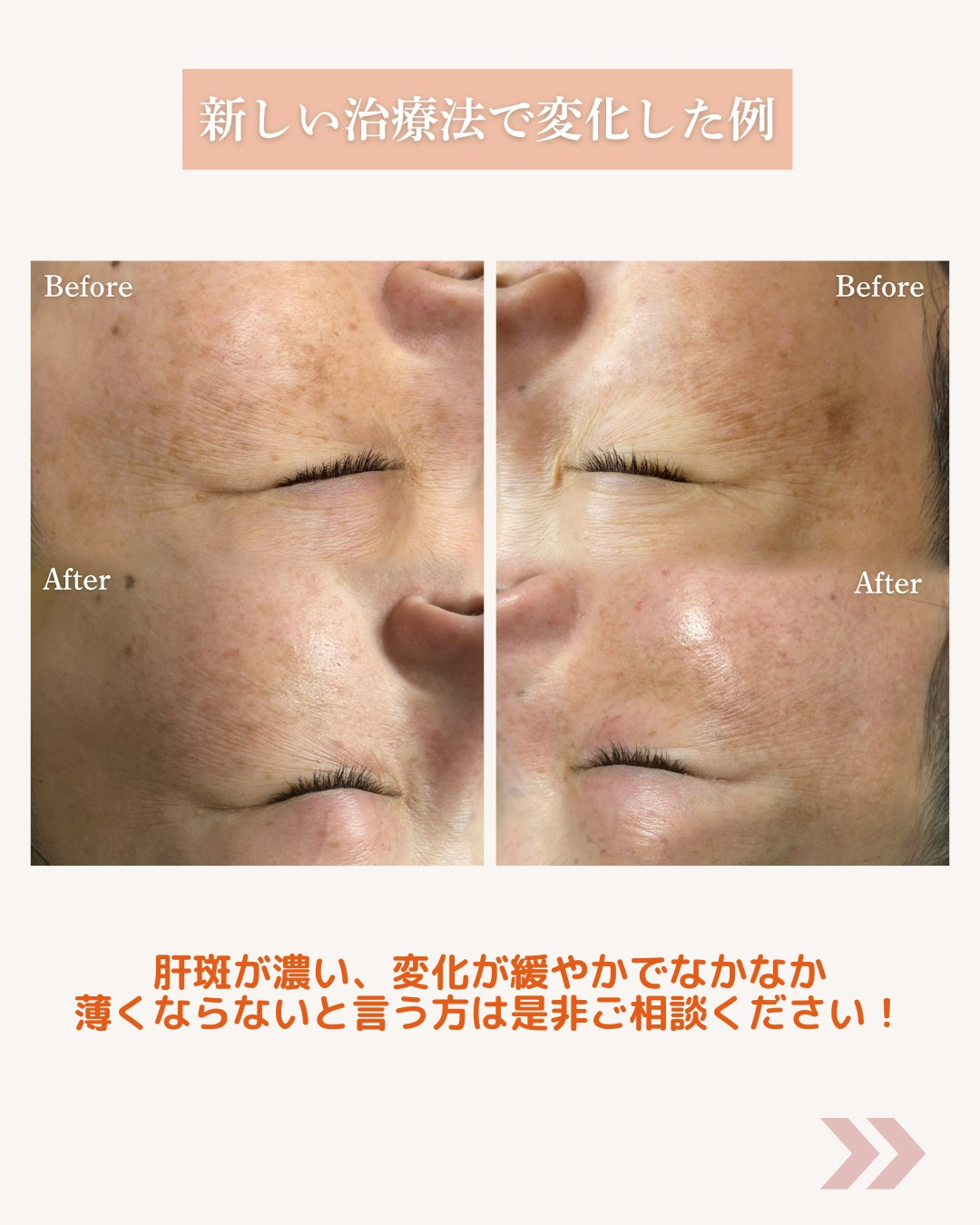 「これって肝斑?」